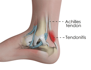 Achilles Tendinitis - Everything You Need To Know
