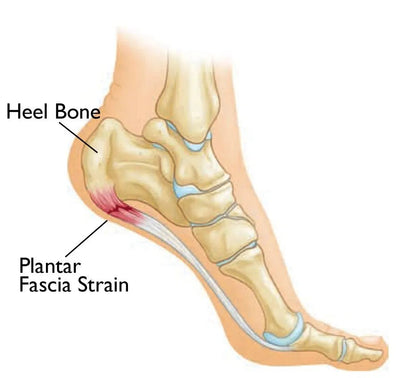 Plantar Fasciitis - Everything You Need To Know